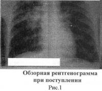 Способ лечения деструктивного туберкулеза легких Способ лечения деструктивного туберкулеза легких