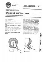 Способ лечения обширных грыж живота Способ лечения обширных грыж живота