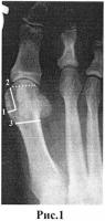 Способ коррекции оси 1 плюсневой кости при лечении hallux valgus Способ коррекции оси 1 плюсневой кости при лечении hallux valgus