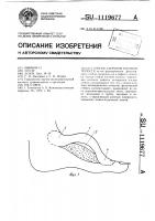 Способ закрытия костной полости Способ закрытия костной полости