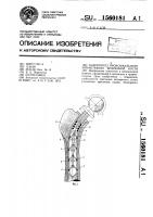Эндопротез проксимального эпиметафиза бедренной кости Эндопротез проксимального эпиметафиза бедренной кости