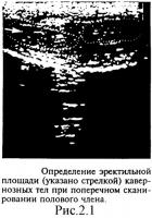 Способ диагностики васкулогенной эректильной дисфункции Способ диагностики васкулогенной эректильной дисфункции