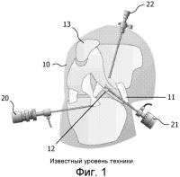 Совмещение и навигация для эндоскопической хирургии на основе интеграции изображений Совмещение и навигация для эндоскопической хирургии на основе интеграции изображений