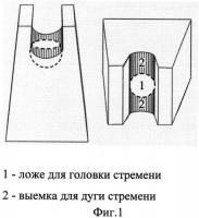 Способ восстановления оссикулярной системы при тимпанопластике Способ восстановления оссикулярной системы при тимпанопластике