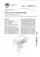 Способ лечения хронического обтурационного панкреотита Способ лечения хронического обтурационного панкреотита