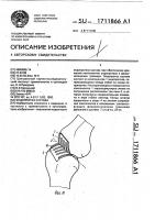 Эндопротез сустава Эндопротез сустава