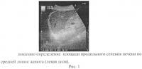 Способ ультразвукового определения объема печени Способ ультразвукового определения объема печени