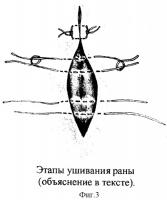 Способ ушивания раны при радикальной операции по поводу эпителиального копчикового хода Способ ушивания раны при радикальной операции по поводу эпителиального копчикового хода