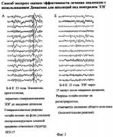 Способ экспресс-оценки эффективности лечения эпилепсии с использованием депакина для инъекций под контролем ээг Способ экспресс-оценки эффективности лечения эпилепсии с использованием депакина для инъекций под контролем ээг