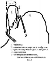 Способ хирургического лечения грыж пищеводного отверстия диафрагмы Способ хирургического лечения грыж пищеводного отверстия диафрагмы