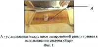 Способ безопасного доступа в брюшную полость у пациентов с послеоперационными внутрибрюшными осложнениями Способ безопасного доступа в брюшную полость у пациентов с послеоперационными внутрибрюшными осложнениями