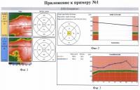 Способ комбинированного лечения диабетического диффузного макулярного отека Способ комбинированного лечения диабетического диффузного макулярного отека