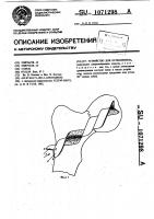 Устройство для остеосинтеза Устройство для остеосинтеза