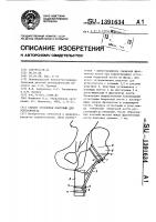 Способ установки пластины для остеосинтеза Способ установки пластины для остеосинтеза