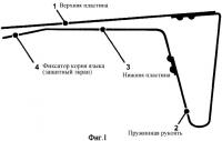 Устройство для получения трахеобронхиального содержимого при патологии бронхолегочной системы Устройство для получения трахеобронхиального содержимого при патологии бронхолегочной системы