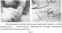 Способ изготовления временных коронок Способ изготовления временных коронок