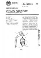Способ лечения пенетрирующих пилородуоденальных язв Способ лечения пенетрирующих пилородуоденальных язв