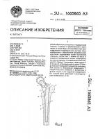 Эндопротез бедренной кости Эндопротез бедренной кости