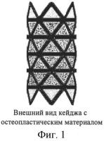 Имплантат для замещения тотальных протяженных дефектов длинных трубчатых костей Имплантат для замещения тотальных протяженных дефектов длинных трубчатых костей