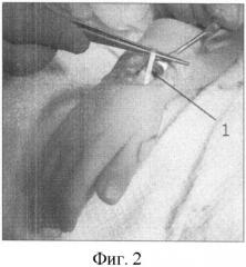 Способ лечения приводящей контрактуры первого пальца кисти у больных с артрогрипозом (патент 2373881)