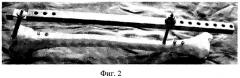 Устройство для интрамедуллярного остеосинтеза большеберцовой кости с блокированием винтами (патент 2262320)