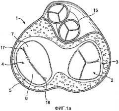 Устройство и способ для уменьшения размера клапана сердца (патент 2491035)