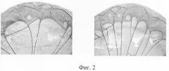 Способ оценки дисфункции желчного пузыря (патент 2292044)