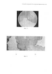 Способ лазерной облитерации варикозных вен (патент 2591841)