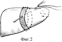 Способ резекции печени (патент 2278617)