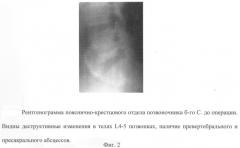 Способ инструментальной фиксации пояснично-крестцового отдела при воспалительных заболеваниях позвоночника (патент 2271165)