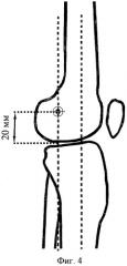 Способ остеосинтеза аппаратом suv-frame при контрактурах коленного сустава (патент 2440058)