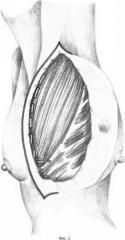 Способ мастэктомии с сохранением большой грудной мышцы (патент 2335249)