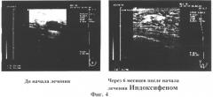 Фармацевтическая композиция для лечения и профилактики пролиферативных заболеваний молочной железы (патент 2318508)