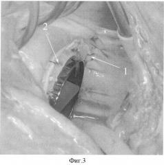 Способ хирургической редукции полости левого предсердия во время операции протезирования митрального клапана в условиях искусственного кровообращения (патент 2348364)
