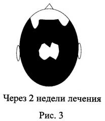 Метод лечения андрогенной алопеции: местное нанесение на очаги облысения гепарина (в составе препаратов для местного лечения) (патент 2517087)