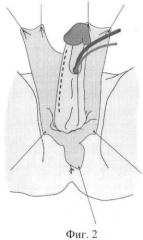 Способ реконструкции наружных женских половых органов при вирилизации наружных половых органов у девочек (патент 2470603)