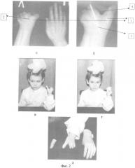 Способ восстановления функции схвата беспалой кисти (патент 2393805)