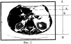 Способ топометрии для рентгенотерапевтического лечения панкреатита (патент 2277377)