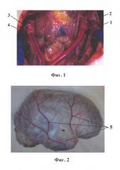 Способ визуализации артериальных и венозных сосудов основания черепа и головного мозга человека для их топографо-анатомического исследования (патент 2621419)