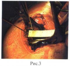 Способ хирургической коррекции проксимального отдела бедренной кости при дисплазии тазобедренных суставов (патент 2492828)