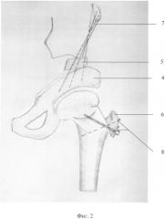 Способ выполнения ротационной транспозиции вертлужной впадины (патент 2534518)