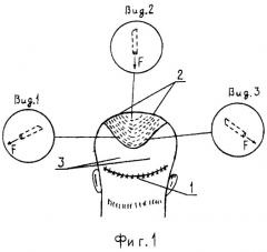 Способ трансплантации волос головы (патент 2295304)