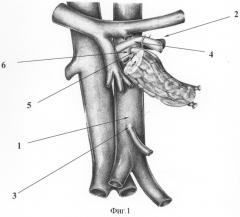 Способ сегментарной трансплантации поджелудочной железы (патент 2311880)