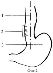 Способ хирургической коррекции ахалазии кардии iv стадии (патент 2474388)