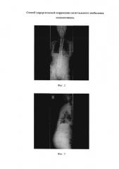 Способ хирургической коррекции сагиттального дисбаланса позвоночника (патент 2629328)
