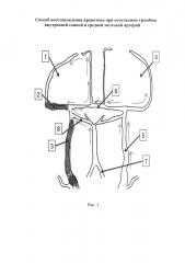 Способ восстановления кровотока при сочетанном тромбозе внутренней сонной и средней мозговой артерий (патент 2629046)