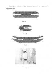 Полимерный эндопротез для замещения дефектов и устранения деформаций век (патент 2653272)