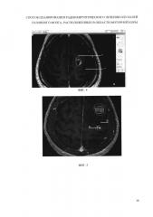 Способ планирования радиохирургического лечения опухолей головного мозга, расположенных в области моторной коры и/или прилегающих к данной области (патент 2655880)