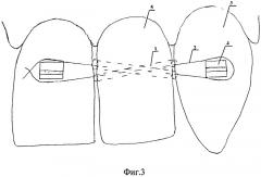 Способ закрытия включенного дефекта в зубном ряду (патент 2524120)