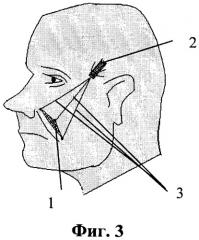 Устройство для подтяжки лица и шеи (патент 2465844)